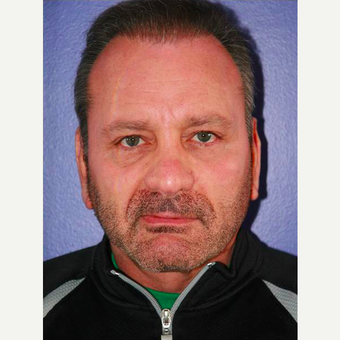 64 year old man treated with Facelift before 3710814