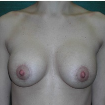 25-34 year old woman treated with Breast Implant Revision after 3376628