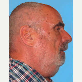 Neck Lift before 3824825