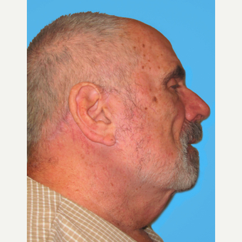 Neck Lift after 3824825
