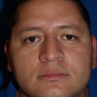 35-44 year old man treated with Rhinoplasty, septoplasty, spreader grafts, and turbinate reduction after 3326241