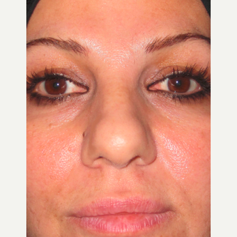 Rhinoplasty before 3814234