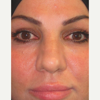 Rhinoplasty after 3814234