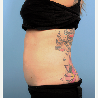 Vanquish ME body contouring procedure - Female before 3070695