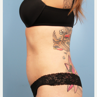 Vanquish ME body contouring procedure - Female after 3070695