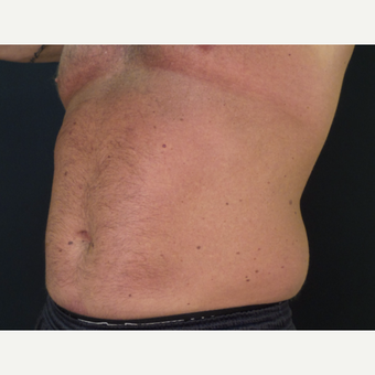 45-54 year old man treated with CoolSculpting before 3134615