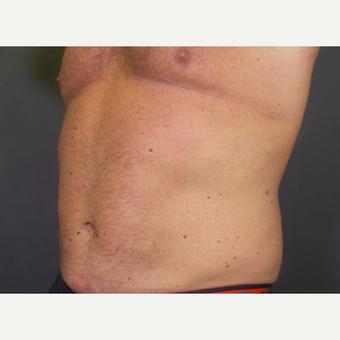 45-54 year old man treated with CoolSculpting after 3134615