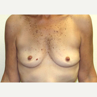 50 year-old woman treated with High profile, Silicone Gel Breast implants. before 3358497