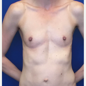 25-34 year old woman treated with Breast Implants before 3060403