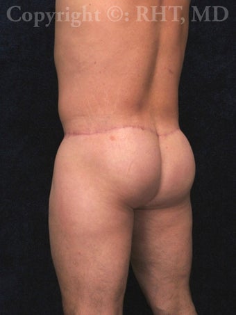 42 year-old male requesting butt lift. after 1014094