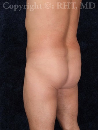42 year-old male requesting butt lift. before 1014094