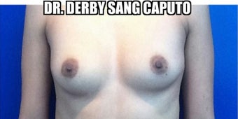 25-34 year old woman treated with Breast Implants before 1974272