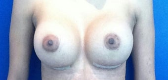 25-34 year old woman treated with Breast Implants after 1974272