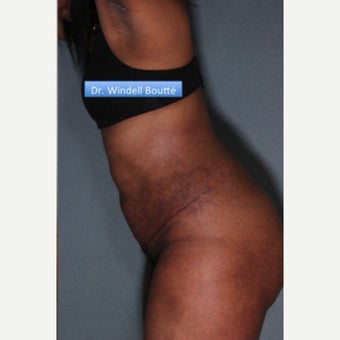 35-44 year old woman treated with SmartLipo Liposuction, Tummy Tuck, and Muscle Repair after 1651788