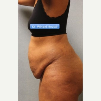35-44 year old woman treated with SmartLipo Liposuction, Tummy Tuck, and Muscle Repair before 1651788