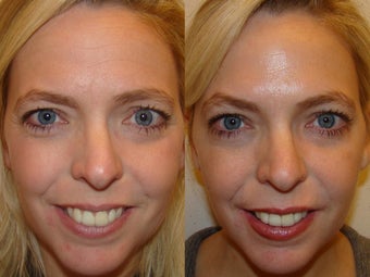 Female treated for glabella, forehead and crows feet before 971191