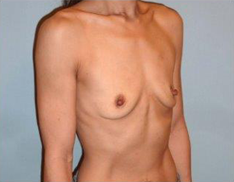 Fuller Breasts for 42 Year old Woman 1371056