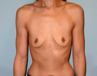 Fuller Breasts for 42 Year old Woman before 1371056
