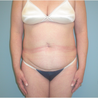 40 year old woman treated with Tummy Tuck before 3343727