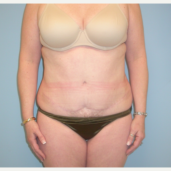 40 year old woman treated with Tummy Tuck after 3343727