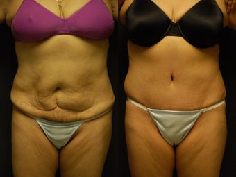 49 y/o patient 4 months post high-lateral tension abdominoplasty without use of drains before 1229180