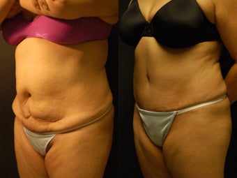 49 y/o patient 4 months post high-lateral tension abdominoplasty without use of drains after 1229180