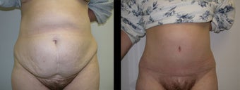 48 year old female tummy tuck before 1231571