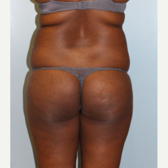 25-34 year old woman treated with Brazilian Butt Lift before 3401322