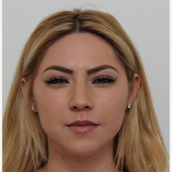 18-24 year old woman treated with Rhinoplasty before 3371531