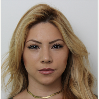 18-24 year old woman treated with Rhinoplasty after 3371531