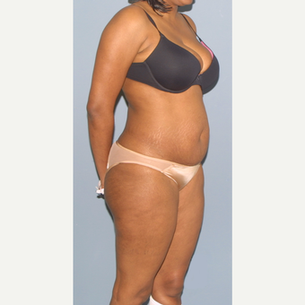 25-34 year old woman treated with Tummy Tuck before 3559025