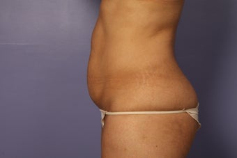 Tummy tuck and liposuction before 687605
