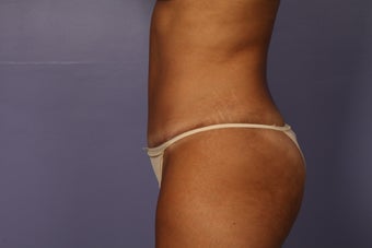 Tummy tuck and liposuction after 687605