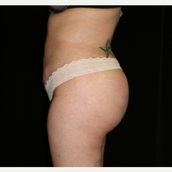 25-34 year old woman treated with Brazilian Butt Lift after 3372322