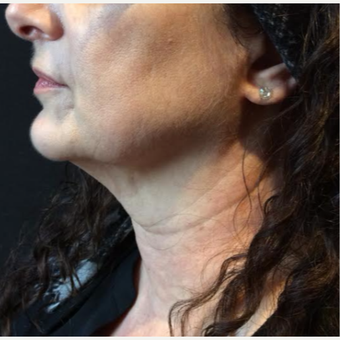 55-64 year old woman treated with Kybella after 3669959