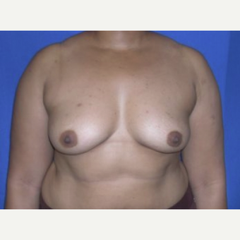 35-44 year old woman treated with Breast Augmentation before 3220133