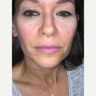 45-54 year old woman treated with Lip Augmentation after 3451834