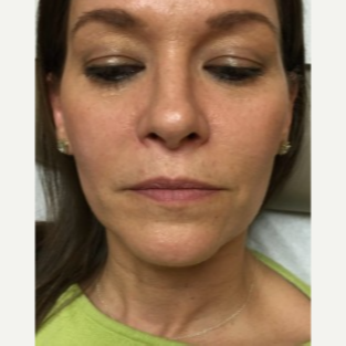 45-54 year old woman treated with Lip Augmentation before 3451834