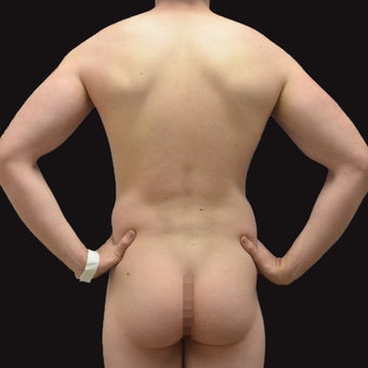 35-44 year old man treated with Liposculpture before 1962756