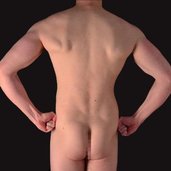 35-44 year old man treated with Liposculpture after 1962756