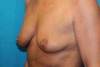 45-54 year old woman treated with Breast Lift and Breast Augmentation 3524408