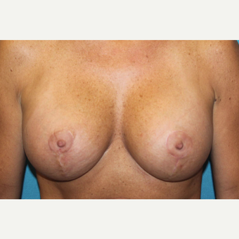 45-54 year old woman treated with Breast Lift and Breast Augmentation after 3524408