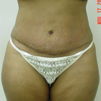35-44 year old woman treated with Liposuction after 3283260