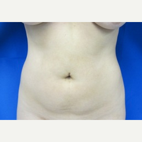 Liposuction before 3094209