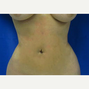 Liposuction after 3094209