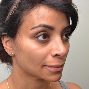35-44 year old woman treated with Rhinoplasty after 3747700
