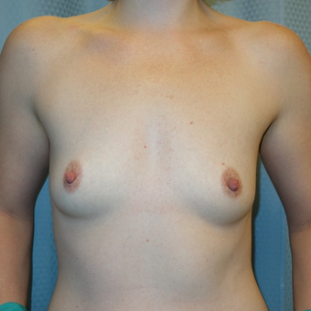 35-44 year old woman treated with Breast Augmentation before 3239664