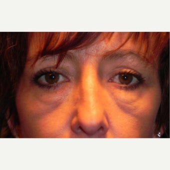 35-44 year old woman treated with Eyelid Surgery & RESET Laser Skin Resurfacing for Eyelid Festoons before 1930053
