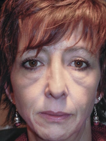 35-44 year old woman treated with Eyelid Surgery & RESET Laser Skin Resurfacing for Eyelid Festoons 1930053