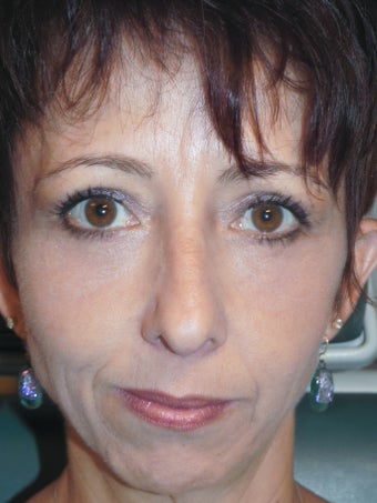 35-44 year old woman treated with Eyelid Surgery & RESET Laser Skin Resurfacing for Eyelid Festoons 1930053